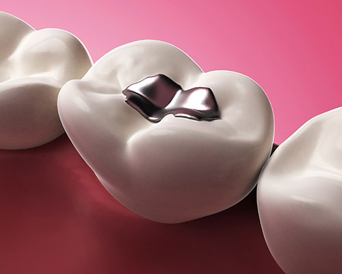 Safe Silver Amalgam Removal with a Holistic Dentist